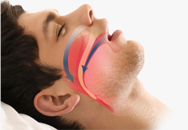 Sleep Apnea Treatment at Sound Sleep Clinic